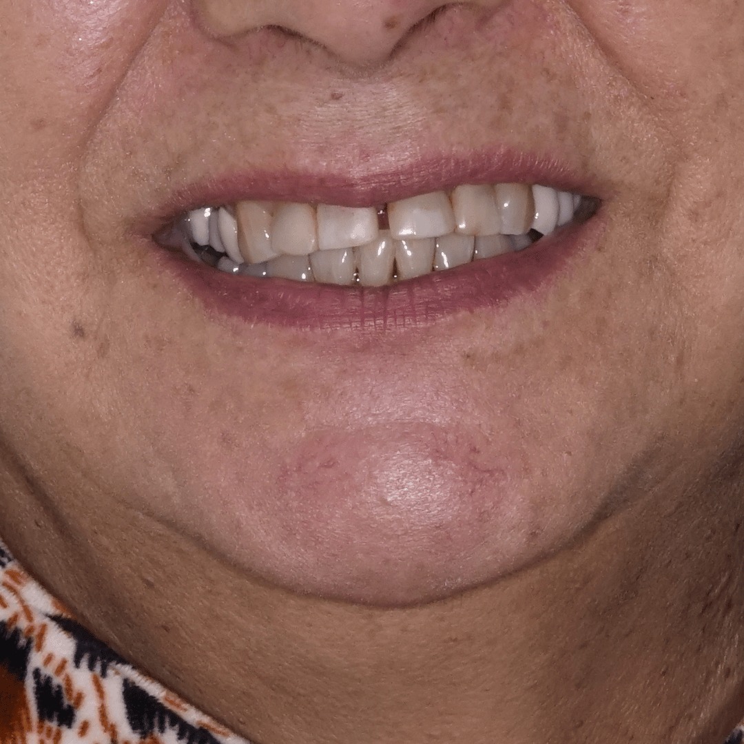 Caso 05 antes