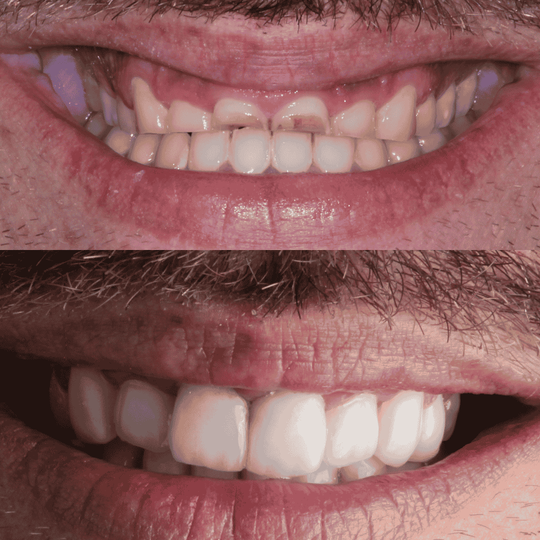 Dientes anteriores con desgaste en los bordes incisales evaluados en Clínica Cataluña