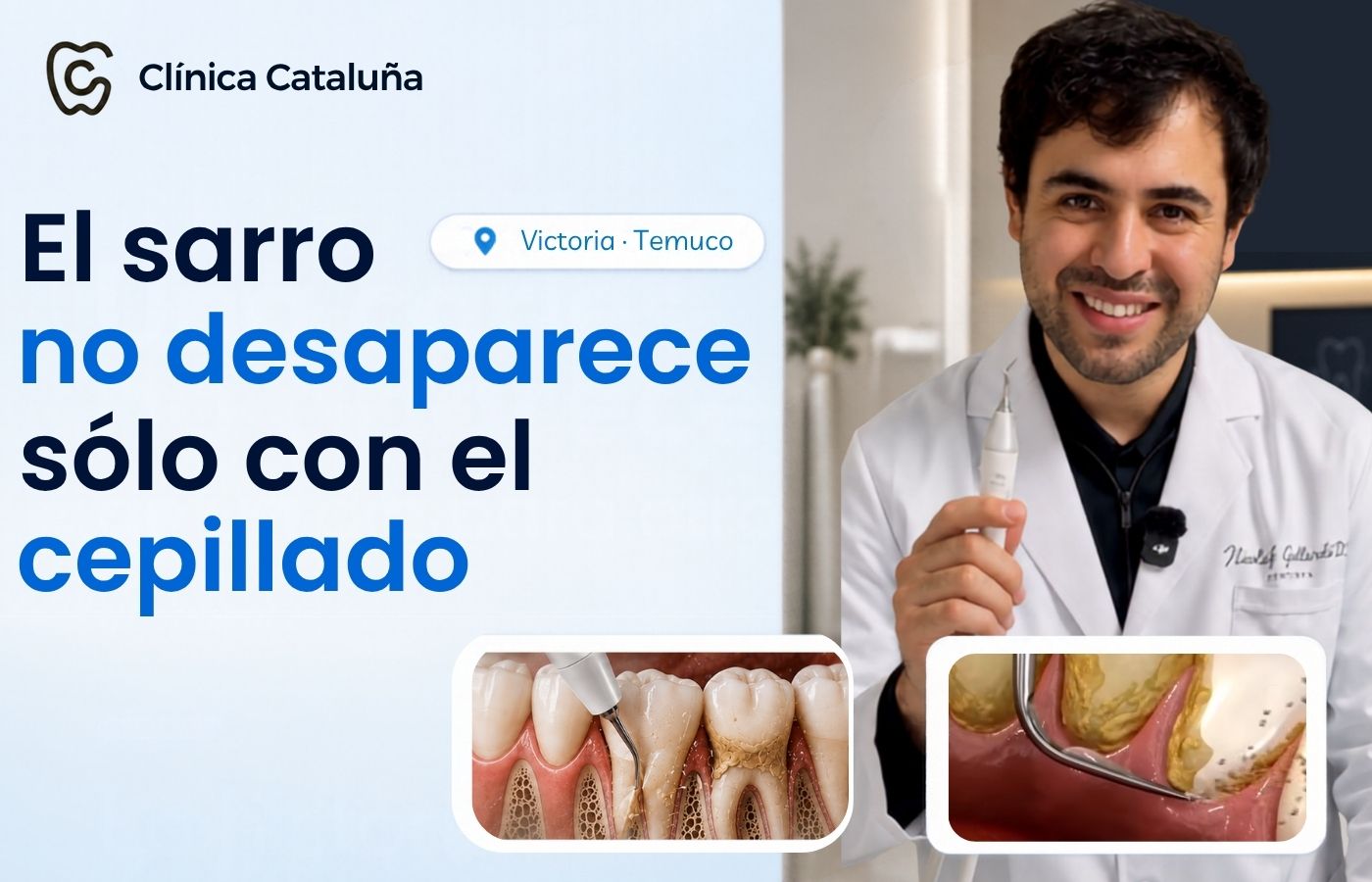 El sarro no desaparece solo con el cepillado: remoción de sarro con instrumental ultrasónico